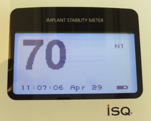 平田10 ISQ値　埋入後約5ヶ月　